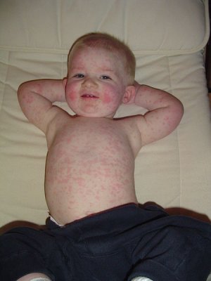 450px-Fifth_disease.jpg