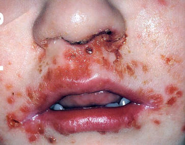 impetigo.jpg