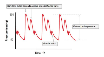 Widened/Wide Pulse Pressure: Definition, Causes & Treatments | Faculty ...