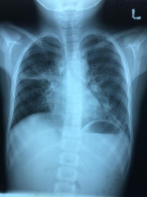 X ray findings - spot diagnosis | Faculty of Medicine